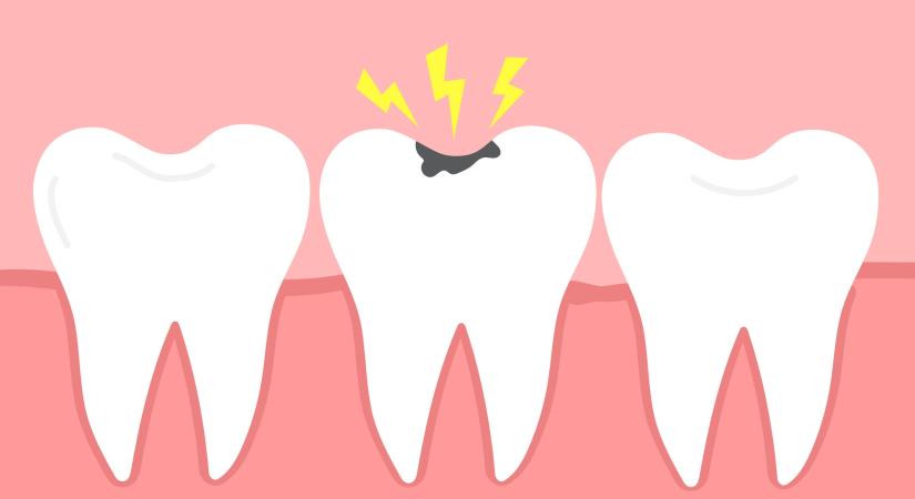Áttörés: új módszer előzheti meg a fogszuvasodást