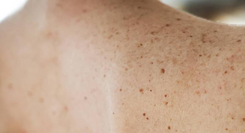 Ennyi anyajegyet lehet eltávolítani egyszerre: a bőrgyógyász válasza meglepő