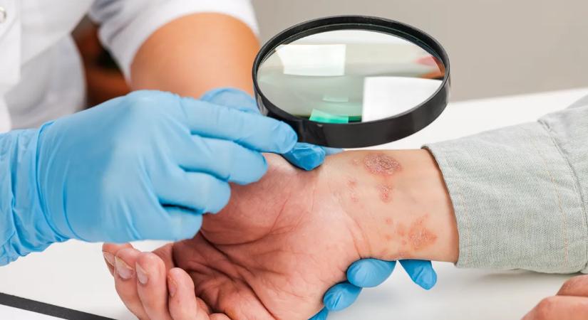 Így kezelhető a pikkelysömör a téli fellángolási időszakban