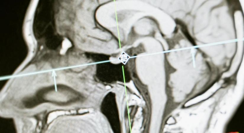 Olyan volt az agya, mint egy 70 évesnek: meghalt a 24 éves demens fiatal