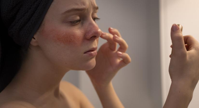 Rosacea télen: hogyan hat a hideg az érzékeny arcbőrre?