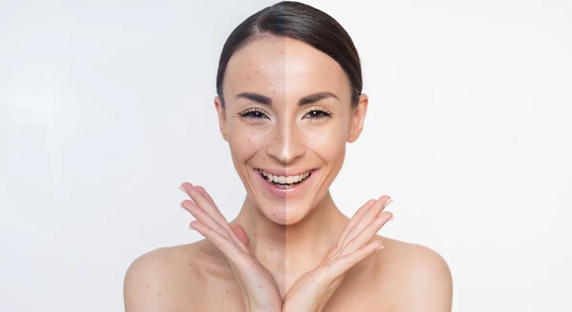 Zsírosodásra hajlamos a bőröd? Ezekkel a termékekkel tarthatod kordában