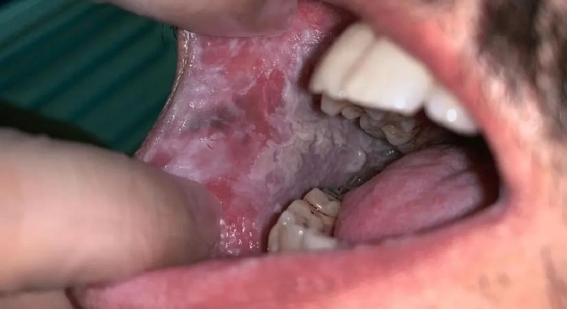 Akár napi egy ital is növelheti a szájrák kockázatát