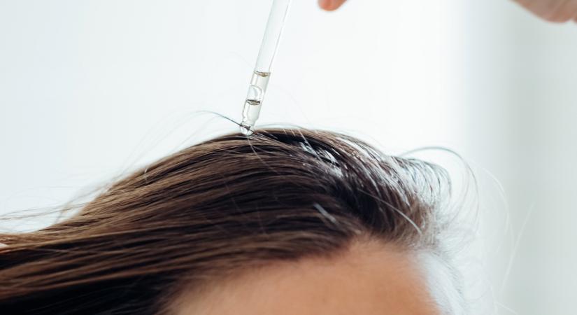 Reménykedhetnek a kopaszodók, egy új szérum hozhatja el a megváltást