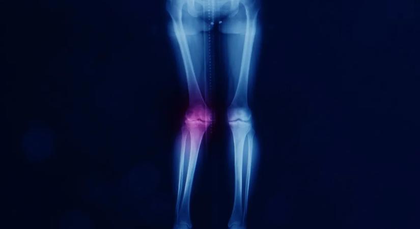 Valgus lábállás: amikor az X-lábúság több mint esztétikai kérdés