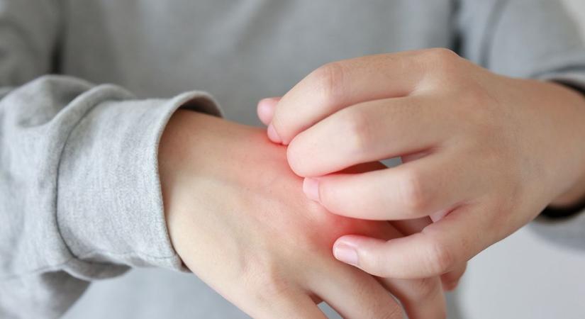 Hidegallergia: diagnózis, kiváltó okok és kezelés – amikor a hideg is veszélyforrás