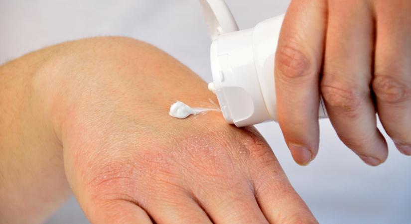 Gyógyszerész tanácsai az ekcéma ellen: télen így kellene ápolni a bőrt