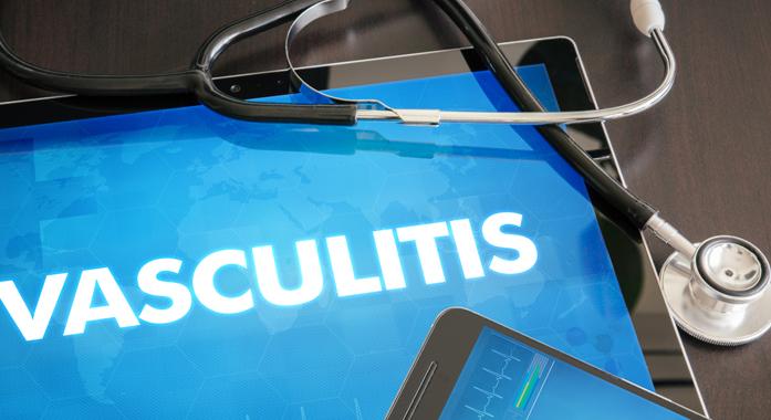 Az érgyulladás (vasculitis) tünetei és kezelése