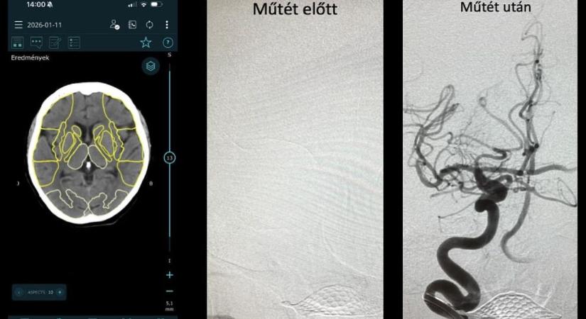 Elképesztő innováció: nagyobb biztonságban, ha stroke-ot kap valaki