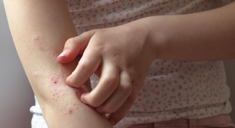 Ekcéma: ezért lehetnek télen súlyosabbak a tünetek