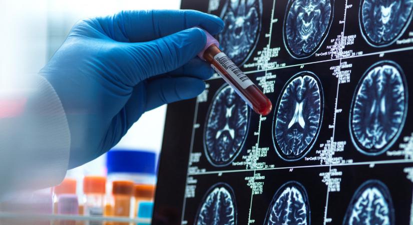 Meghalt a demencia egyik legfiatalabb áldozata, agyát orvosi kutatásokra ajánlotta fel a családja