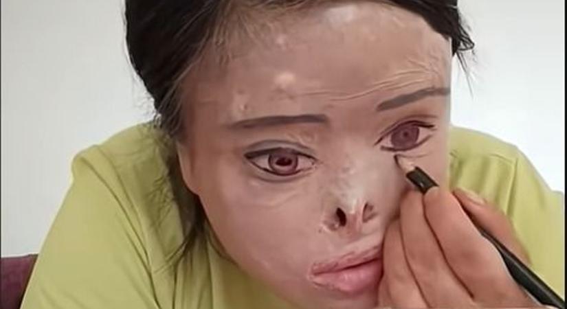 „Az exem savval megégette az arcomat – most sminkkel rajzolom meg a szemeimet"