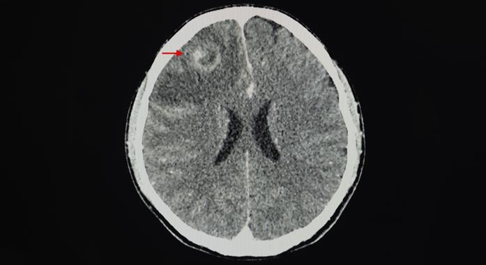 Kontrasztanyagos koponya-CT-vizsgálat