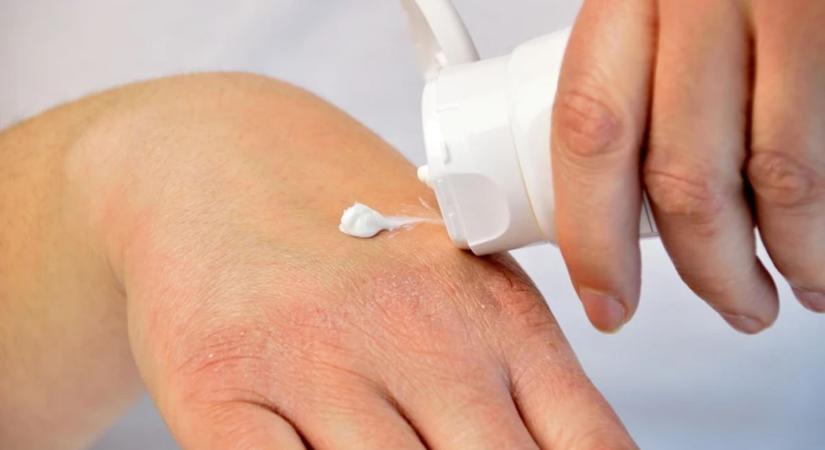 Gyógyszerész tanácsai az ekcéma ellen: télen így kellene ápolni a bőrt