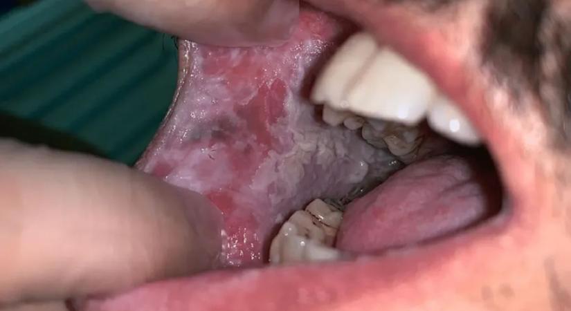 Akár napi egy ital is növelheti a szájrák kockázatát