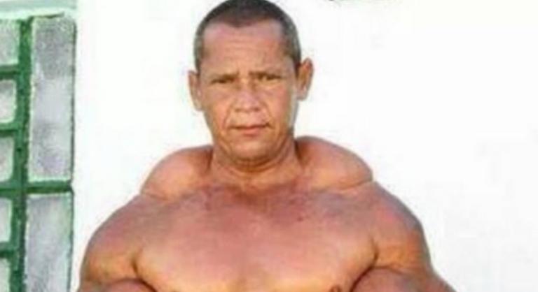 Meghalt a brazil Popeye, aki olajinjekciókkal pumpálta fel a bicepszét