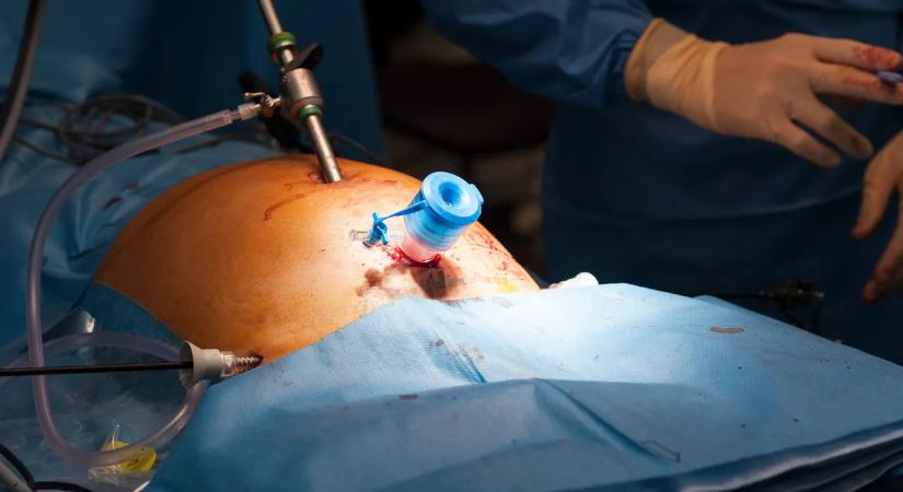 35 kilós daganat temette maga alá a férfi péniszét: az orvosok sem hittek a szemüknek