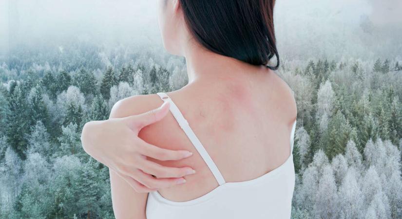 Ekcéma, pikkelysömör és egyéb bőrbetegségek: A bőrgyógyász szerint erre érdemes figyelni télen