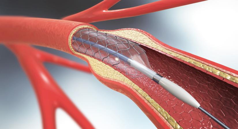 Új eljárással kezelik az érszűkületet Pécsen – Ez lehet a megoldás a végtagamputáció elkerülésére