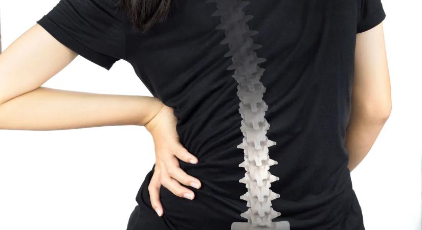 Fáj a derekad, gyorsan kifáradsz? Ezt érdemes tudnod a gerincferdülésről