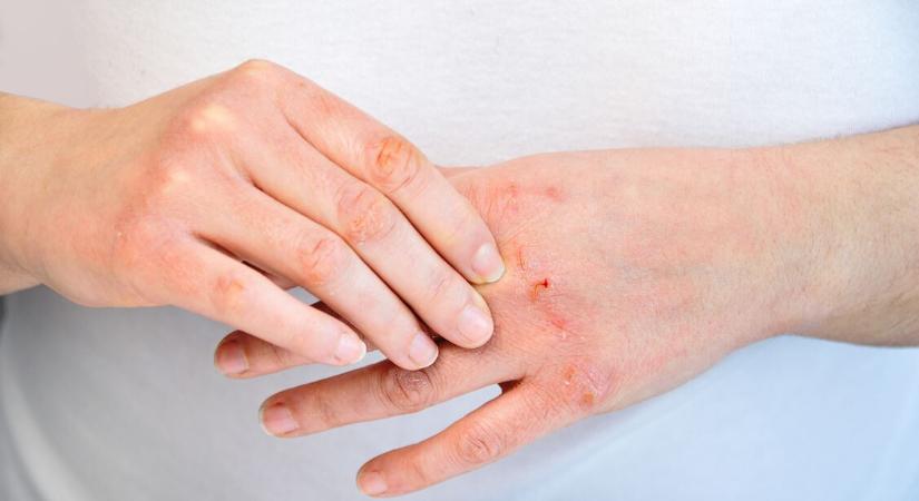 Kisebesedik a kézfejed a hidegtől? Így kezelheted házilag – Mutatjuk, mit javasol a bőrgyógyász