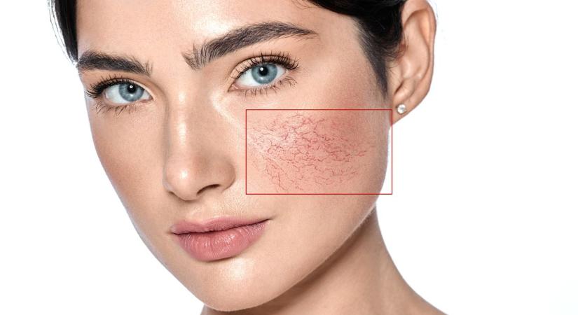 Piros hajszálerek az arcon: mi okozza és mit tehetünk ellenük?