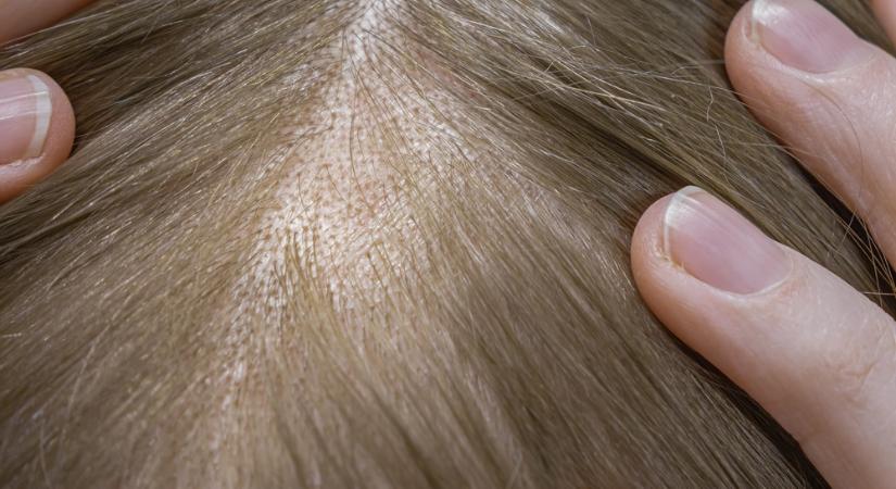 Albert hercegnek megműtötték a fejbőrét