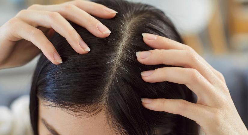 Ha ezekre nem figyelsz, a hajad bánhatja: hajhullás és korpásodás is lehet a vége