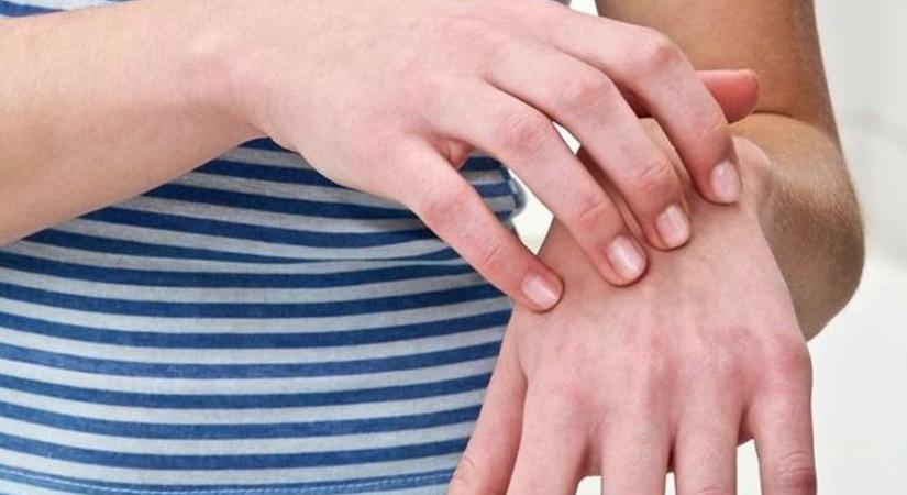 Mi az ekcéma? Tünetei, fajtái, kezelése és házi praktikák