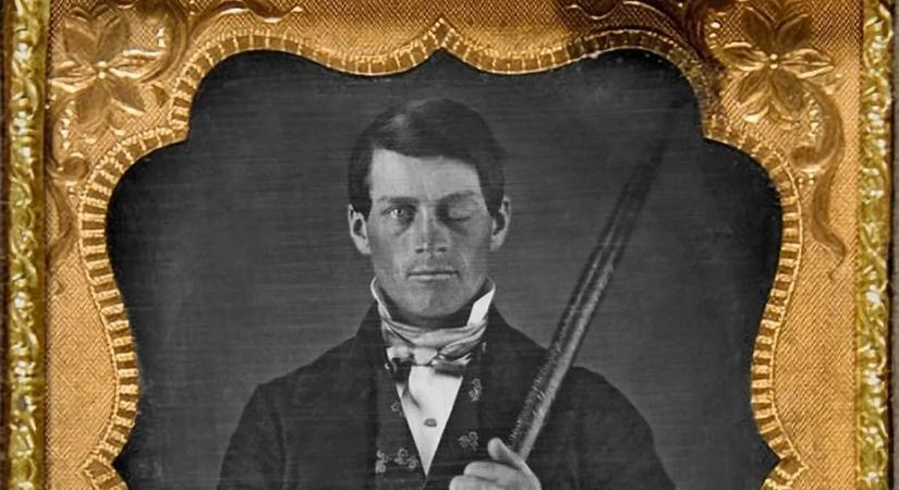 Túlélte, hogy átszúrta egy vasrúd az agyát, de nem maradt ugyanaz az ember