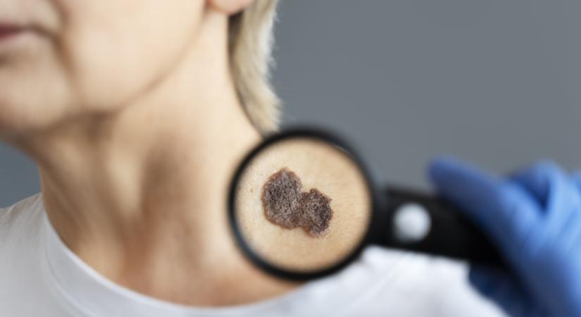 Angiokarcióma: ezek a ritka rák tünetei