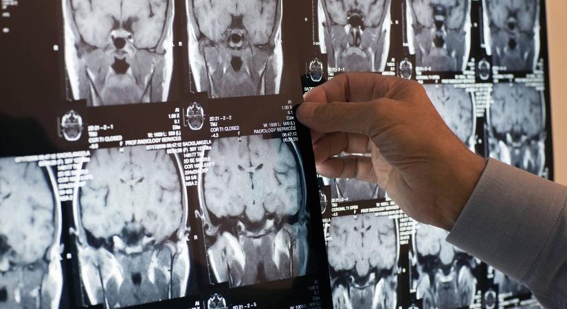 Ez a stroke korai tünete: akár hetekkel korábban figyelmeztethet a szervezet