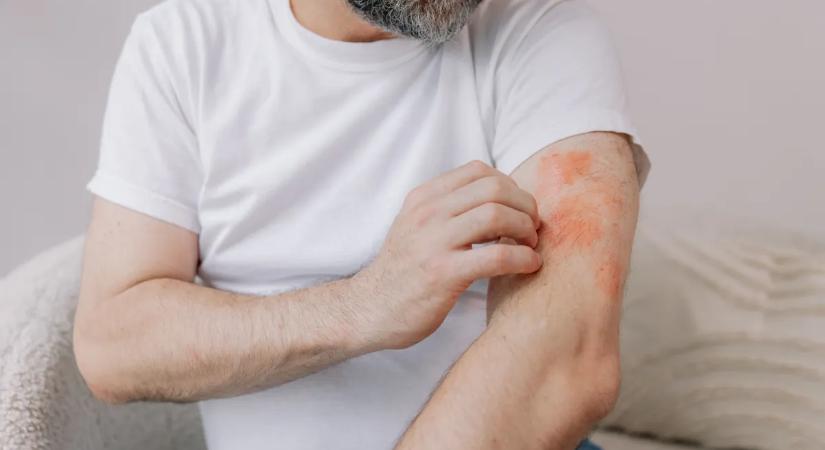 Belobbant az ekcémád a hidegben? Így tehetsz ellene