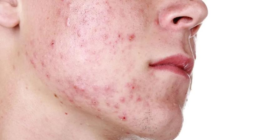 Mindent próbált, de nem múlnak a pattanások? A bőratka kezelés segíthet