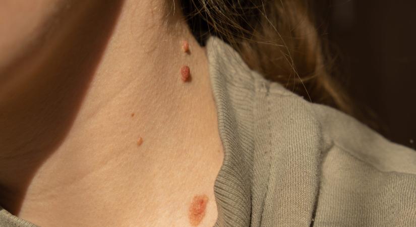 Fibróma eltávolítása otthon – ezért ne állj neki DIY módszerekkel, válassz inkább profi megoldásokat