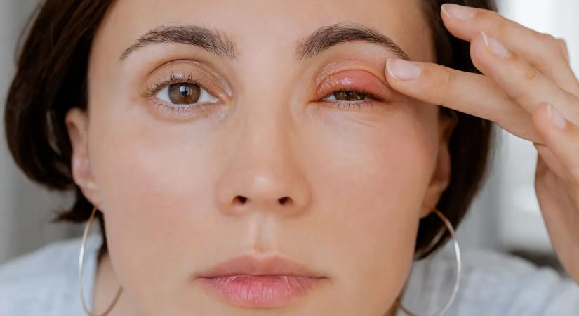 Árpa a szemen: ezért alakul ki és így kezelhető korszerűen