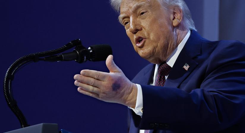 Furcsa zúzódások jelentek meg Donald Trump kezén – mindenki azt találgatja, mi lehet…