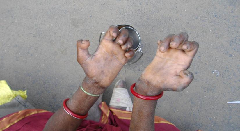 Alice Augusta Ball, az orvostudomány elfeledett zsenije leprás betegek ezrein segített