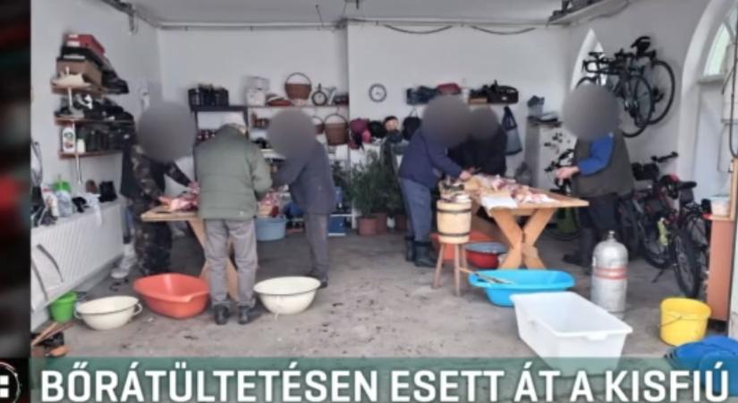 Megégett egy ötéves kisfiú egy disznóvágáson, bőrátültető műtéten esett át