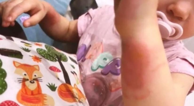 Súlyos égési sérüléseket szenvedett egy berceli óvodás - videó