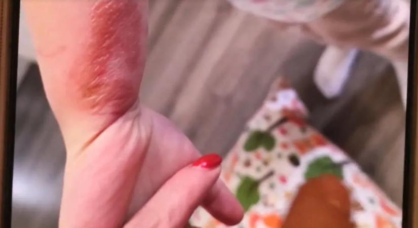 Teljesen ledöbbentek a szülők: súlyos égés sérülésekkel ment haza az óvodából a kis Hanga, kórházba kellett szállítani – videó