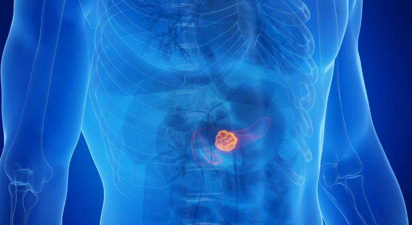 Halálos betegség rejtőzött a hátfájás mögött – figyelni kell a jelekre!