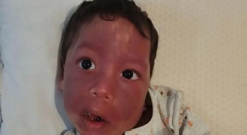 „Nincs kiút, teljesen kétségbe vagyok esve” - Ábel küzdelme a Sturge–Weber-szindrómával