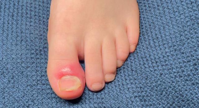 Benőtt lábujjköröm: amikor a köröm „beszúr” – mit tehetsz és hogyan lehet tartósan megoldani