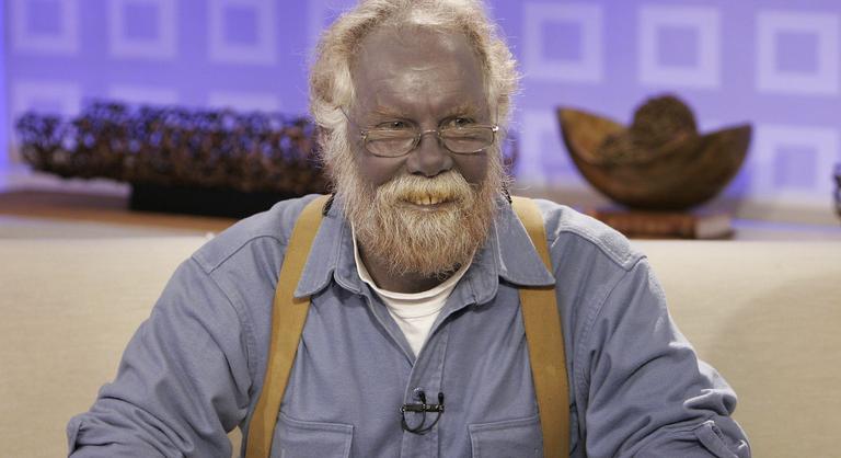 Törpapának nevezték, mert kék volt a bőre, de senki sem tudta, mi történik vele