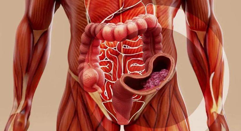 Rendszeresen iszik? Akkor ez a rák nagyobb eséllyel fog kialakulni