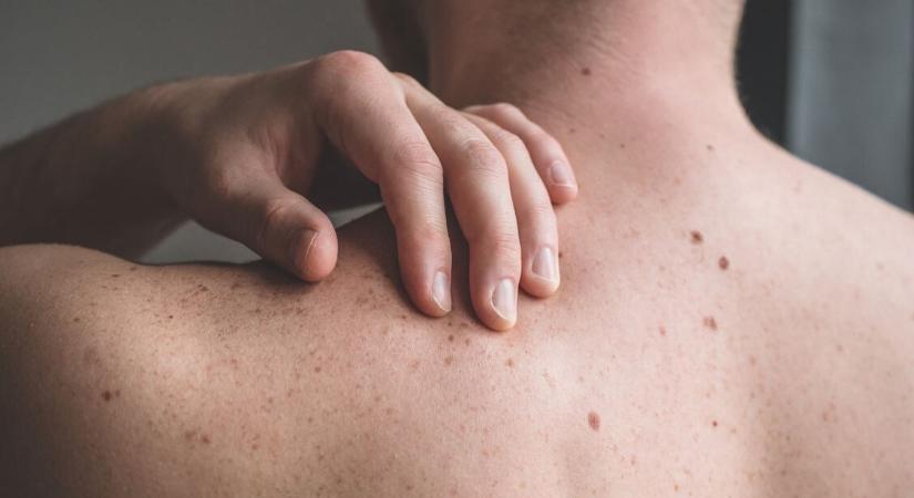 Csomó a bőr alatt: mikor jelez bajt? – Sokszor teljesen ártalmatlan