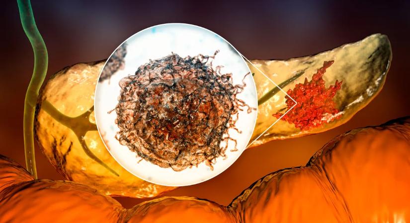 Erre várt az orvostudomány? Végre kiderült, hogyan állítható meg a legkegyetlenebb betegség