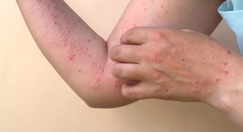 Majomhimlő: járvány van még? Van okunk aggódni?