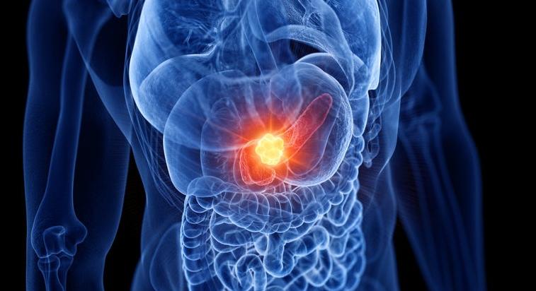 Új remény hasnyálmirigyrák kezelésében